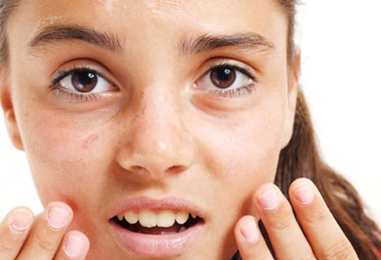 Skin dryness
