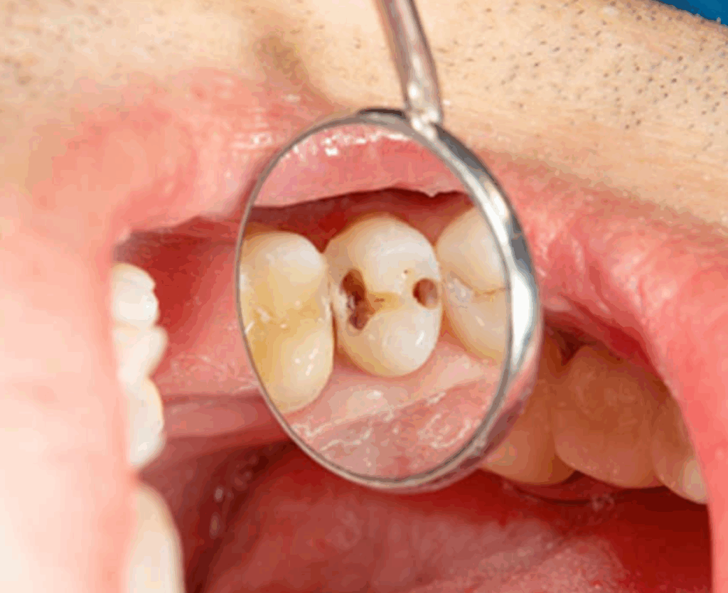 herbal powder for teeth cavity