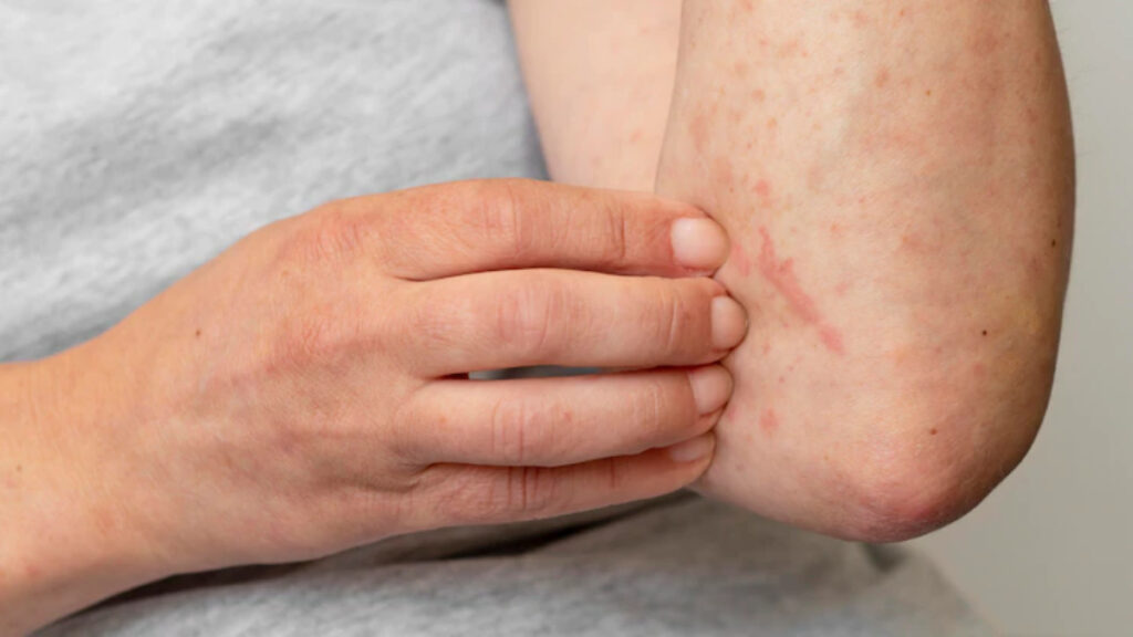 Allergic reaction