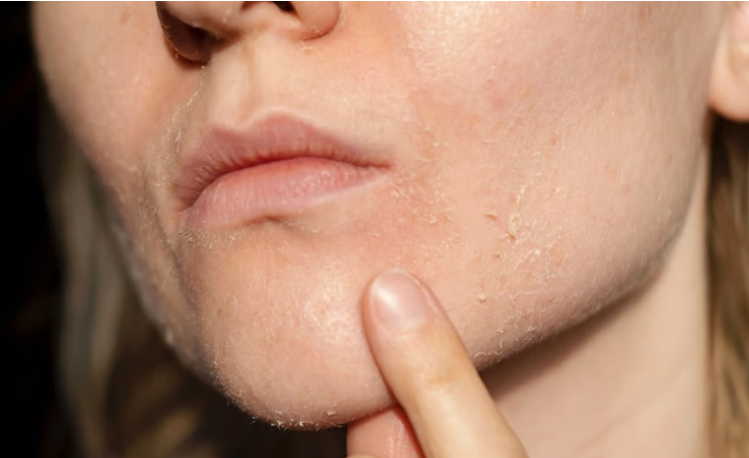 dry skin care tips
