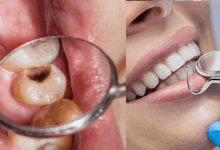 natural remedies for cavities