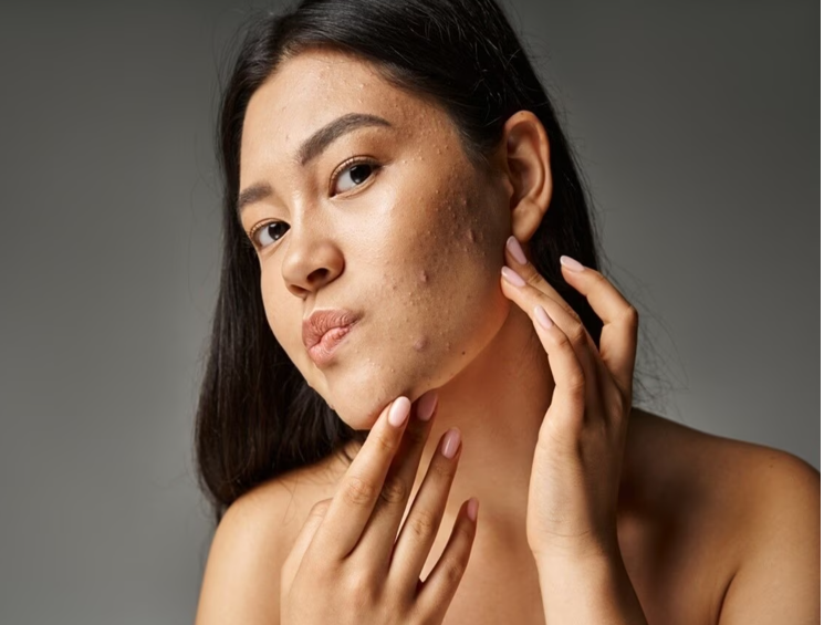 oily pimple skin care tips