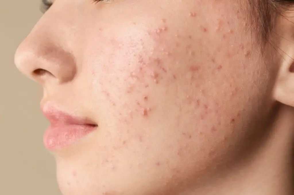 pimple face product