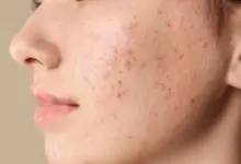 pimple face product