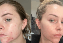 skin care tips in monsoon