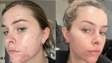skin care tips in monsoon