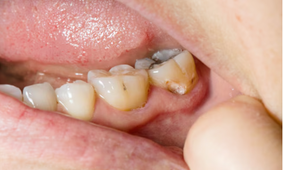 teeth cavity remedy