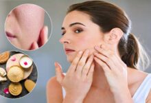 Open pores ke liye use kare ye gharelu upay