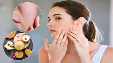 Open pores ke liye use kare ye gharelu upay