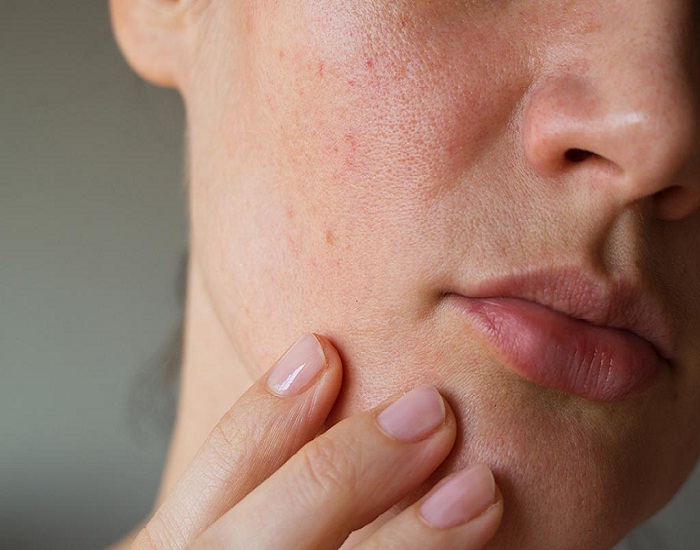 Open pores