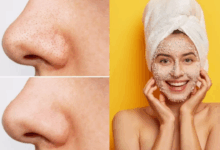 blackheads hatane ke natural tarike