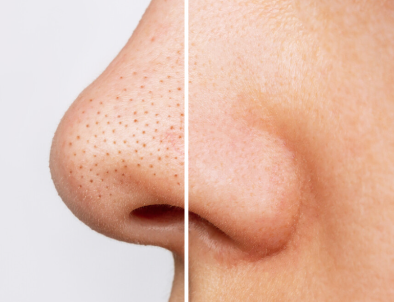 blackheads nikalne ke gharelu upaay
