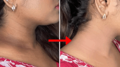 dark neck pigmentation ko kese hataye