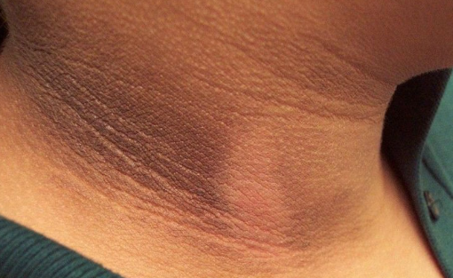 how to remove dark neck pigmentation