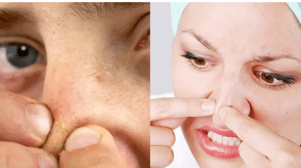 natural way to remove black heads