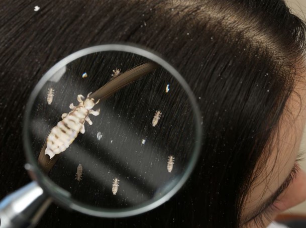 Head lice