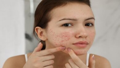 Pimples hatane ke 5 gharelu upay
