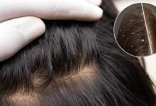 Sir se head lice nikalne ke 3 nuskhen