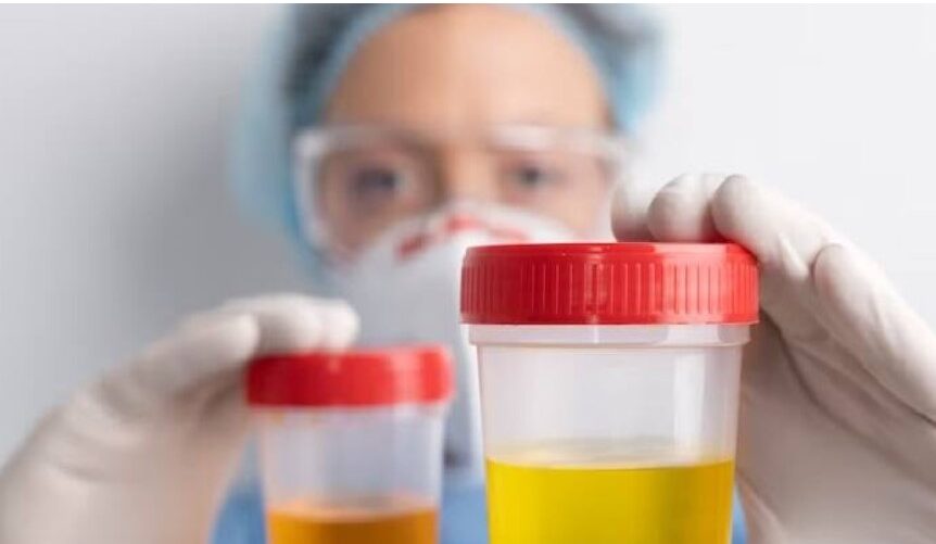 Urine test